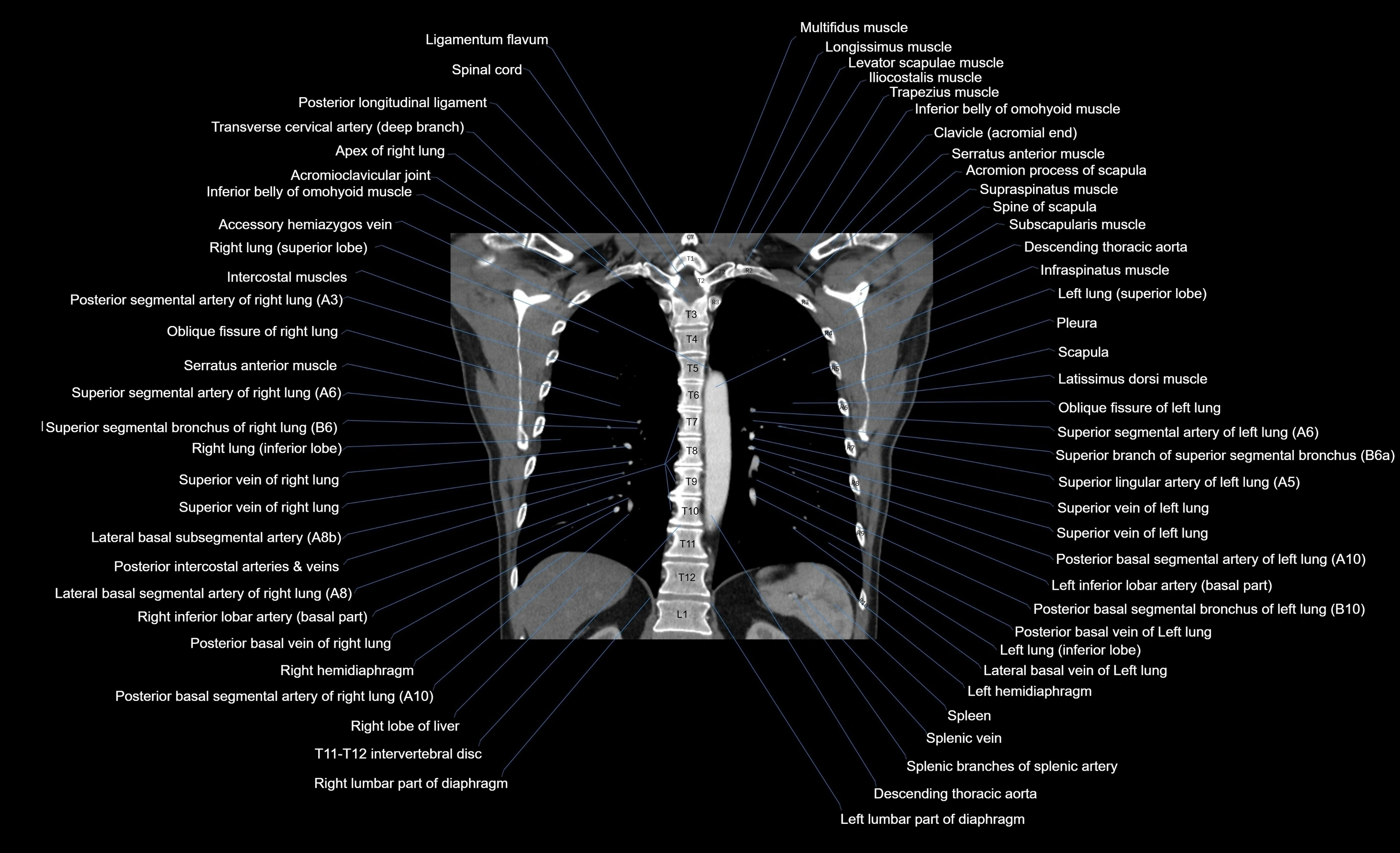 CT chest (thorax) labelled coronal cross sectional anatomy radiology image-00041.webp